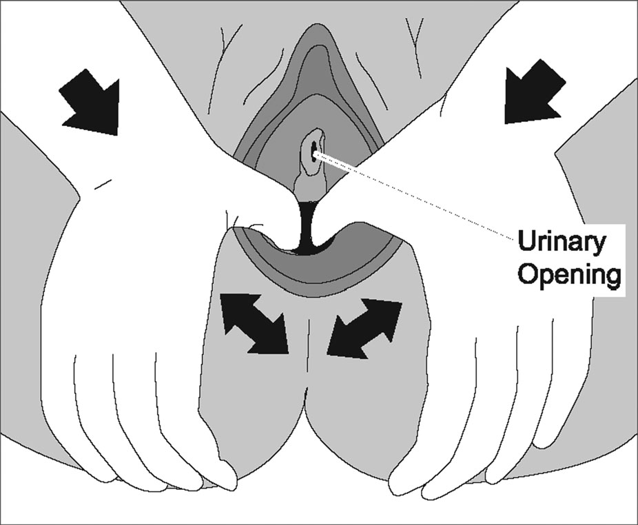 Both thumbs inside the vaginal opening, pressing downward and outward toward the sides, with the urinary opening at the top labeled so it can be avoided.